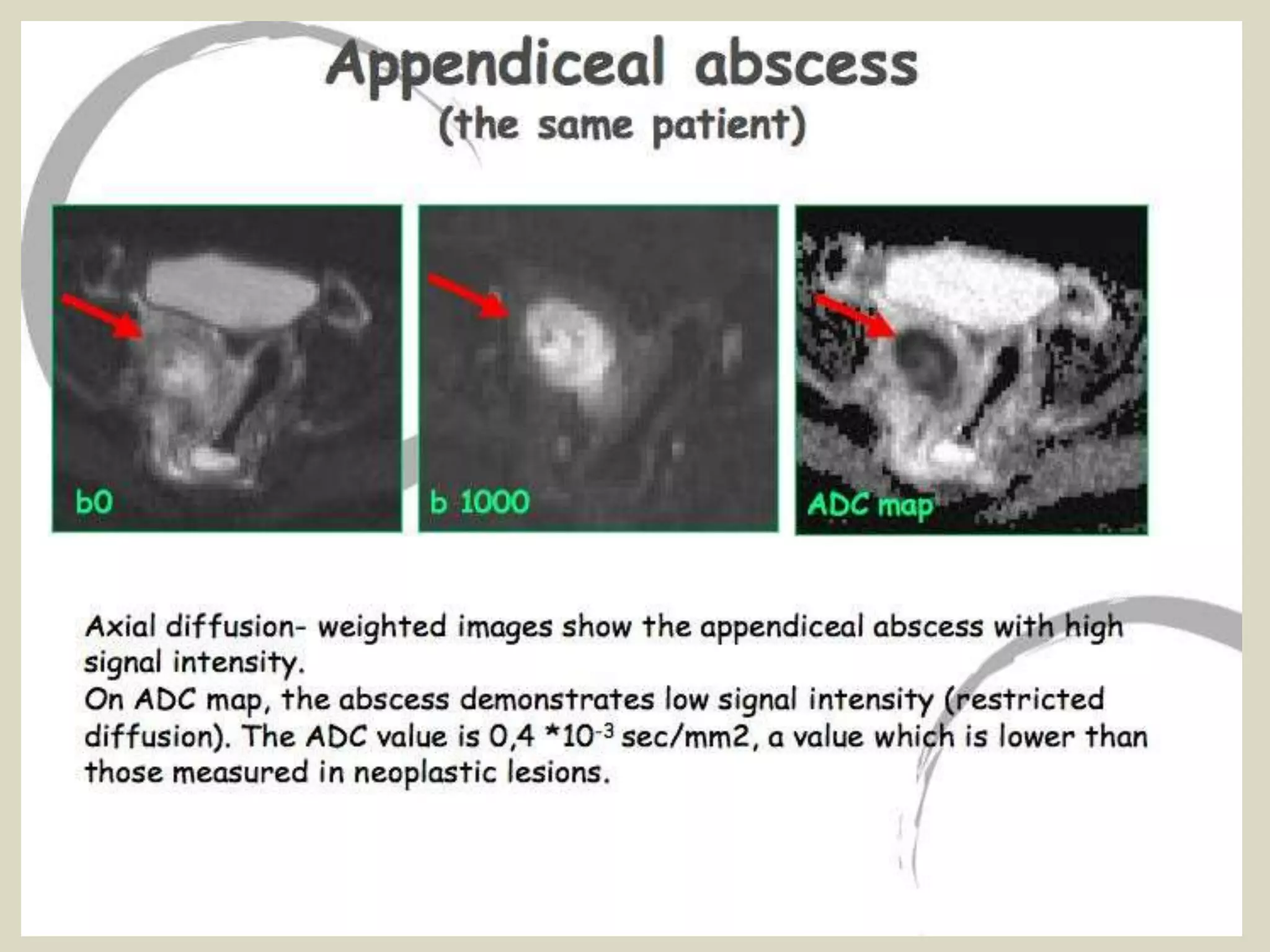 Presentation1, radiological application of diffusion weighted images in ...