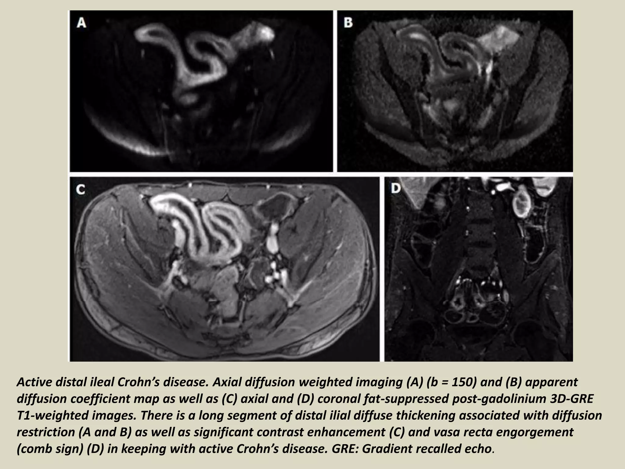 Presentation1, radiological application of diffusion weighted images in ...