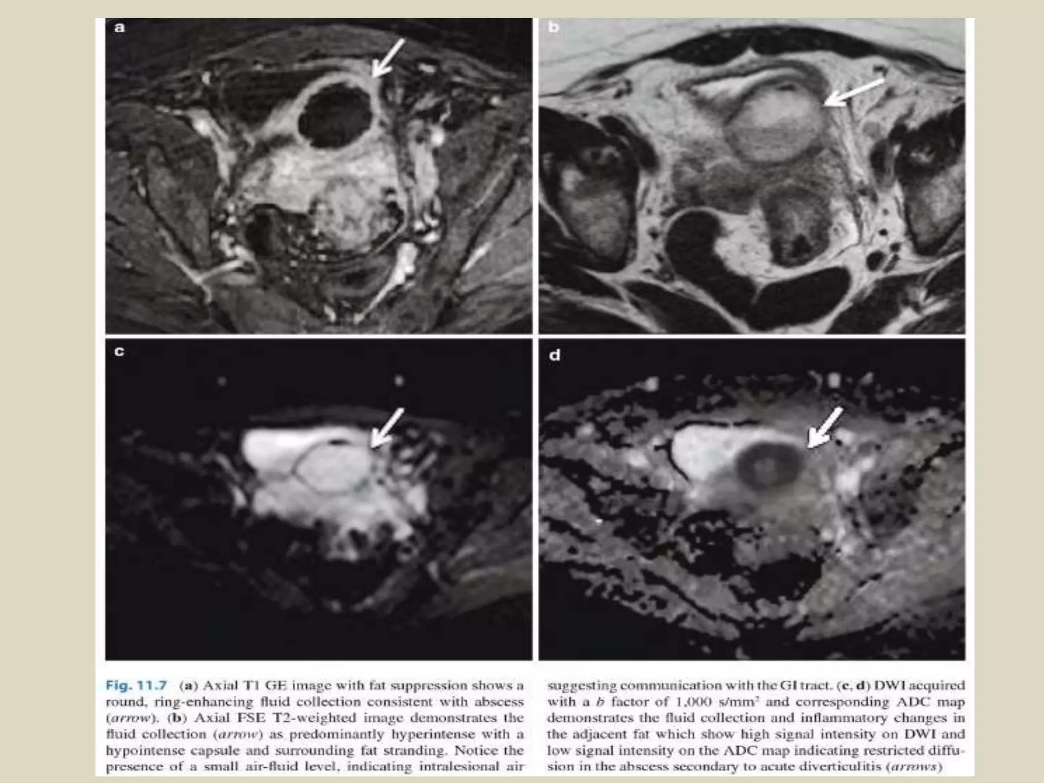 Presentation1, radiological application of diffusion weighted images in ...