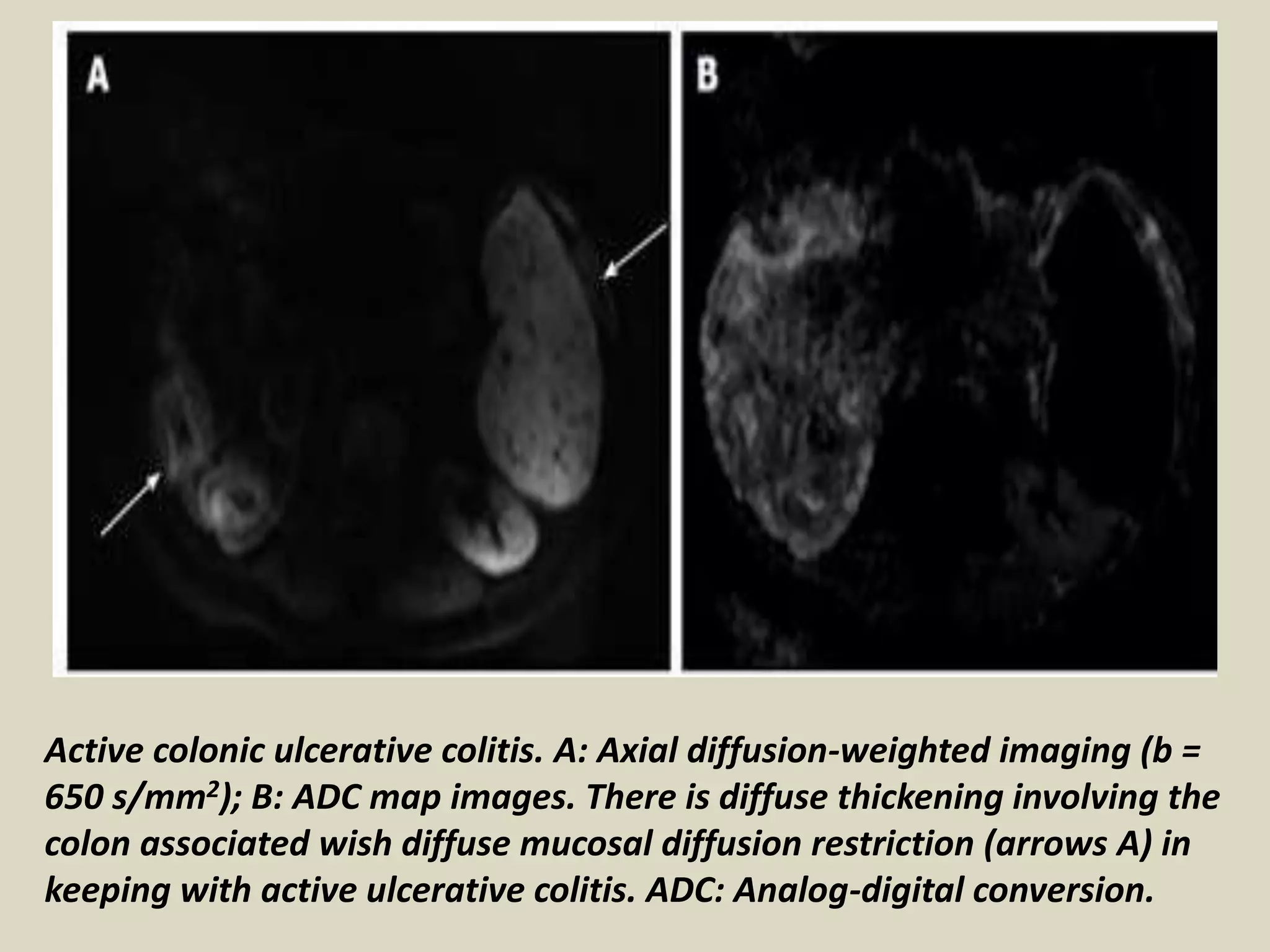 Presentation1, radiological application of diffusion weighted images in ...