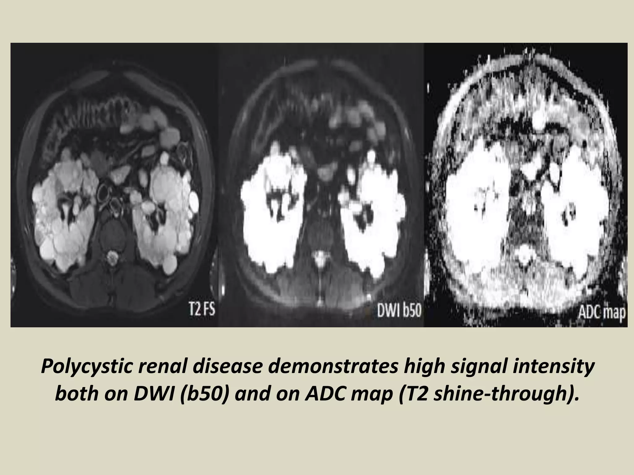 Presentation1, radiological application of diffusion weighted images in ...