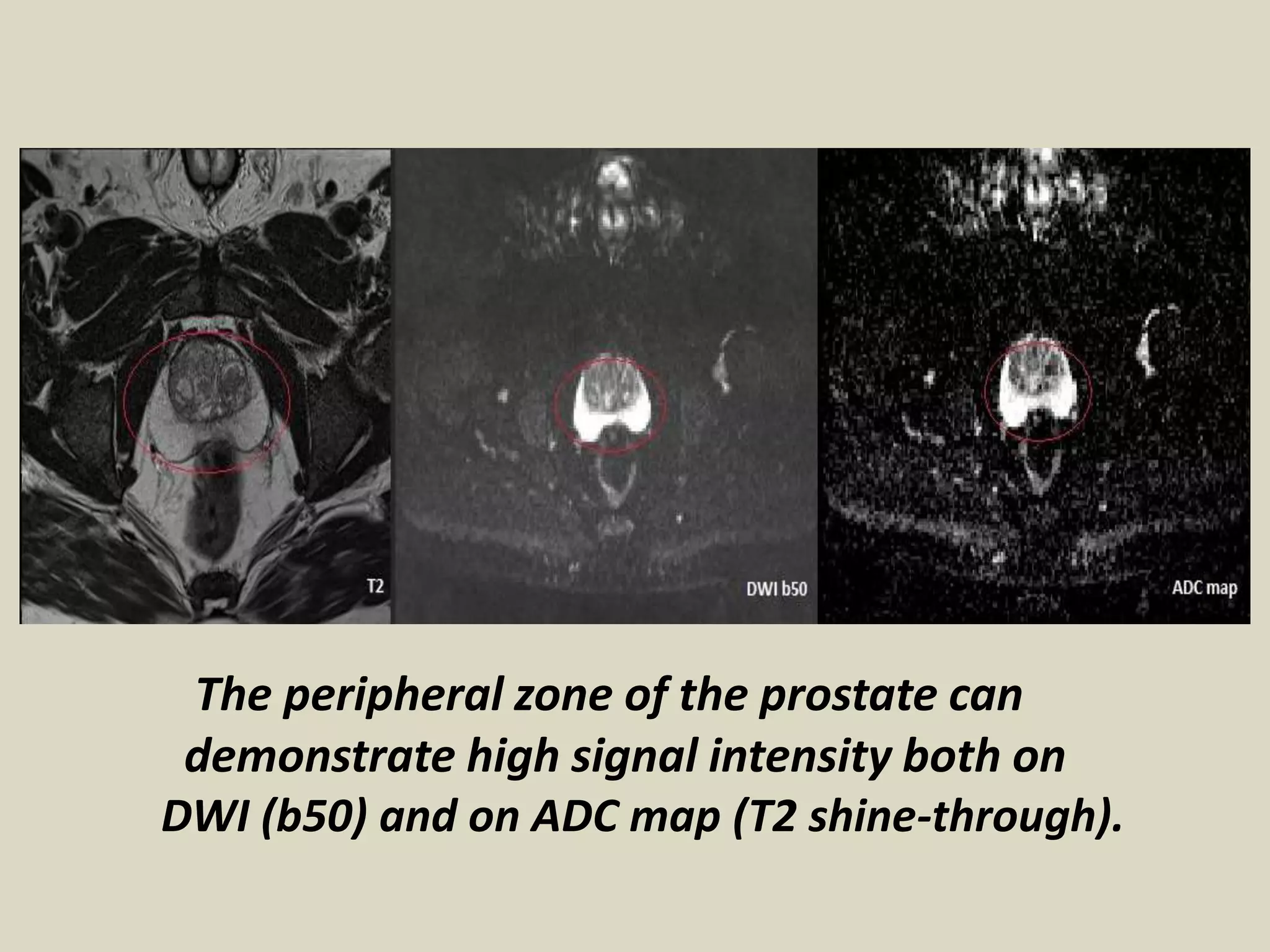 Presentation1, radiological application of diffusion weighted images in ...