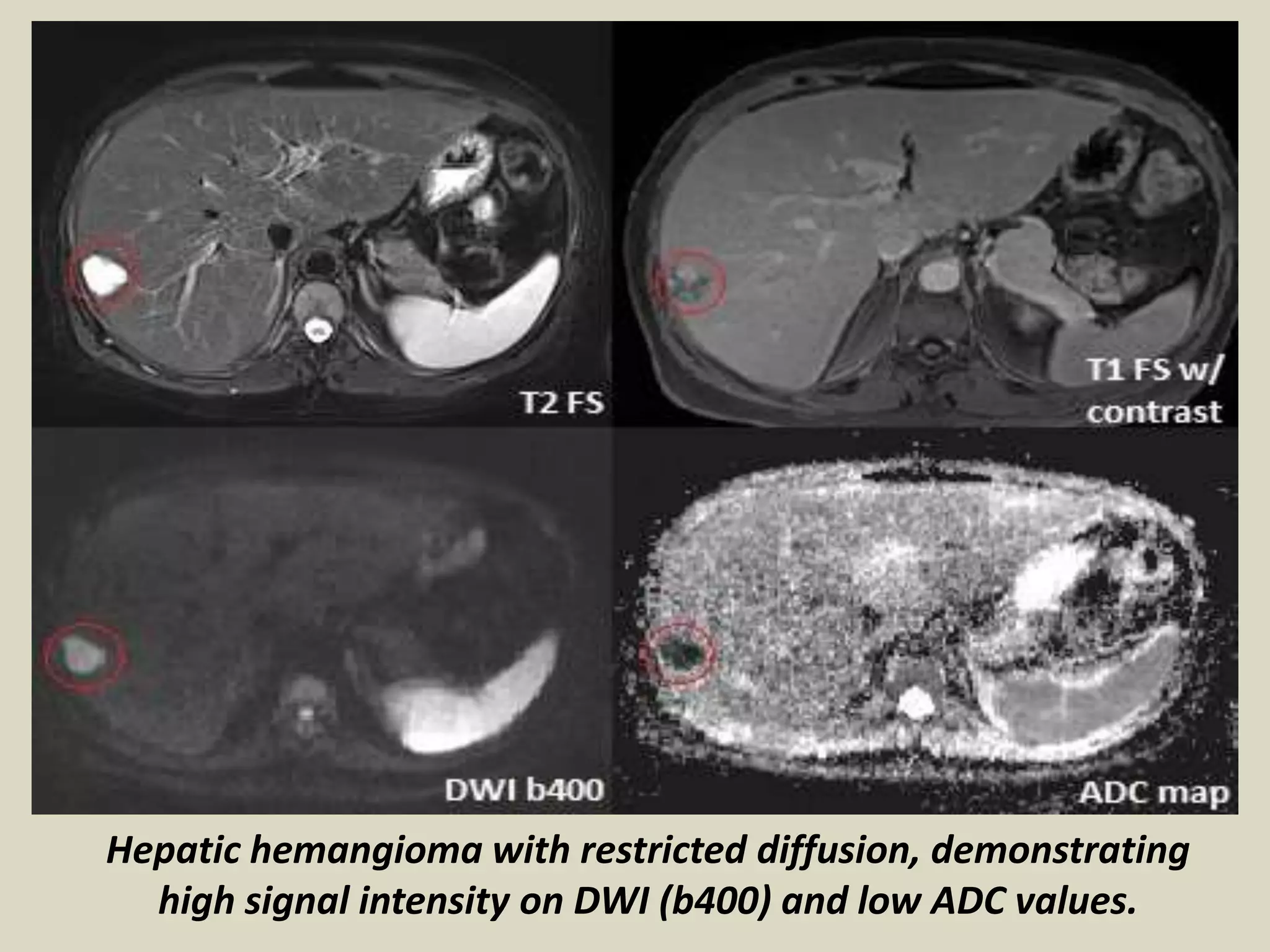 Presentation1, radiological application of diffusion weighted images in ...