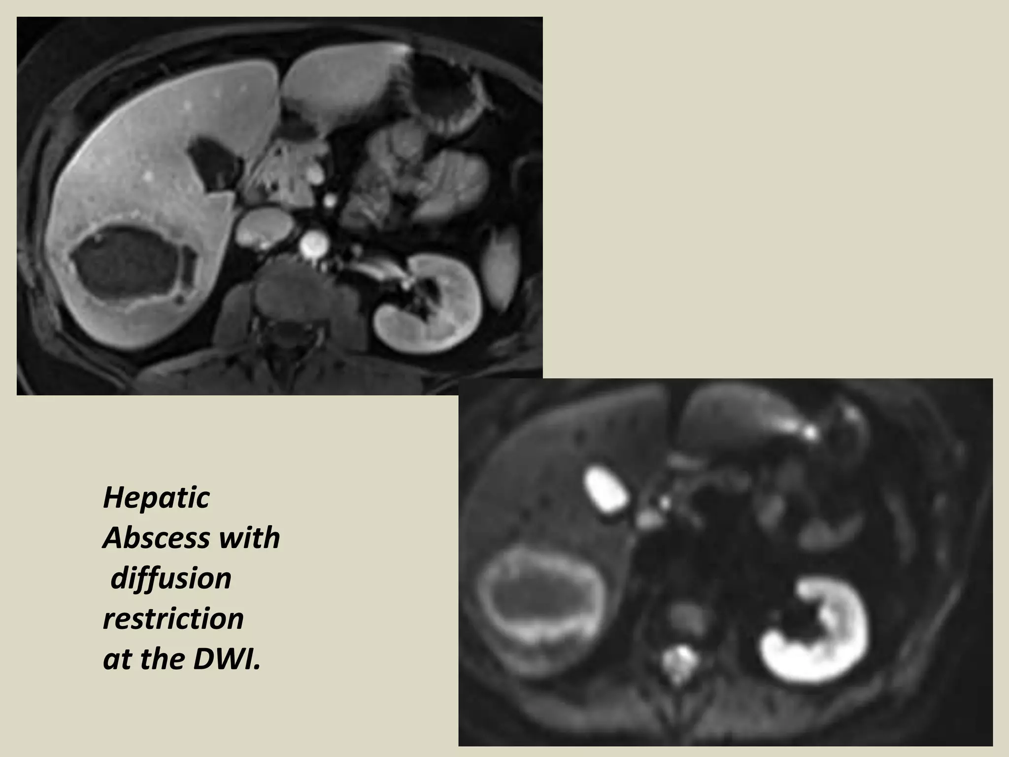 Presentation1, radiological application of diffusion weighted images in ...