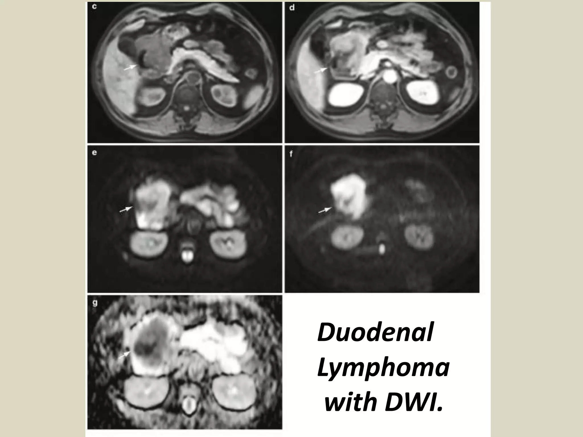 Presentation1, radiological application of diffusion weighted images in ...