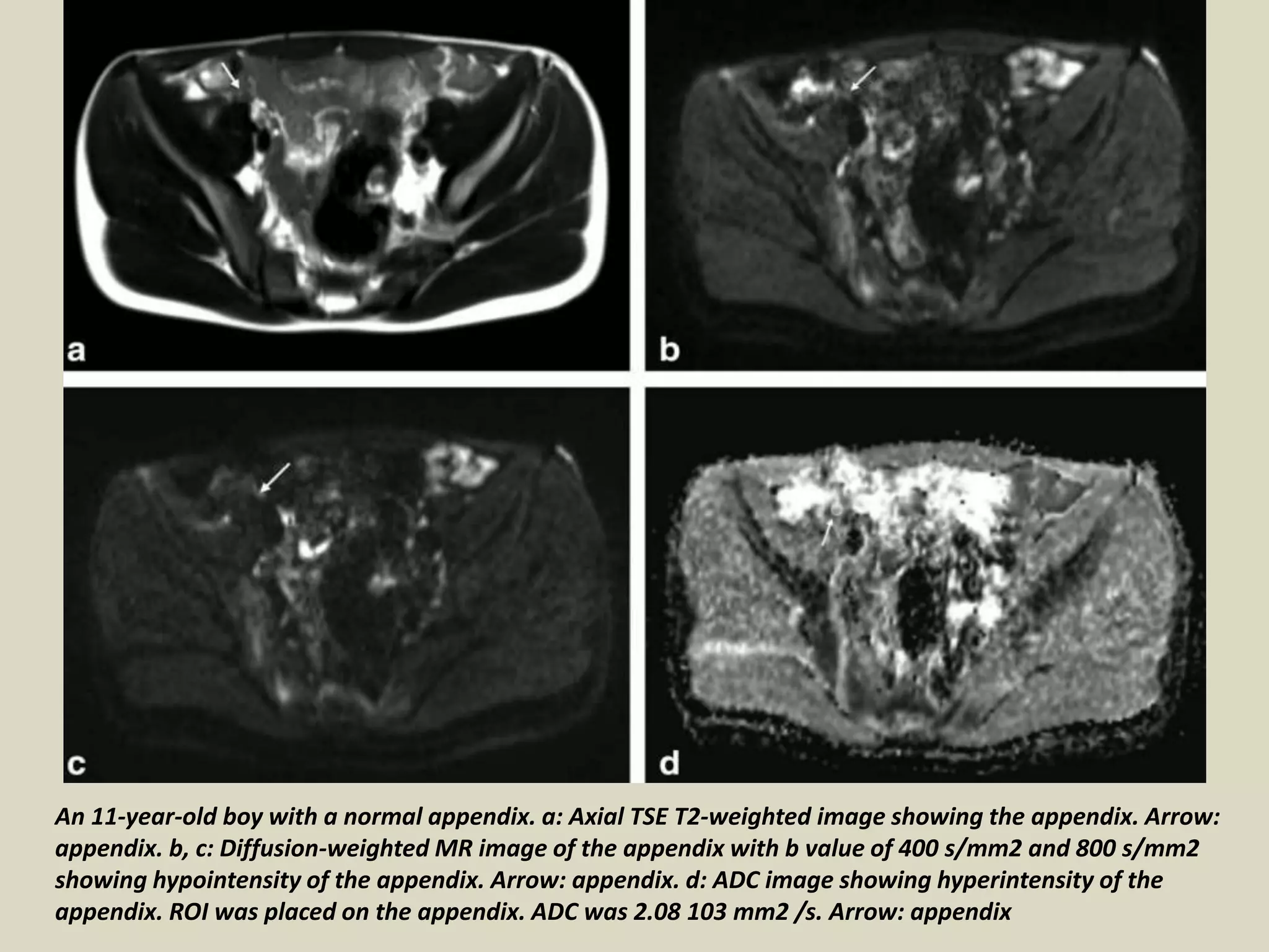 Presentation1, radiological application of diffusion weighted images in ...