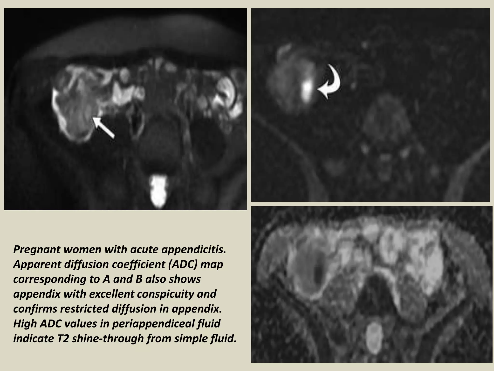 Presentation1, radiological application of diffusion weighted images in ...