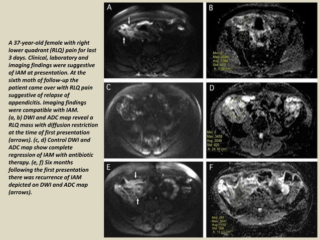 Presentation1, radiological application of diffusion weighted images in ...