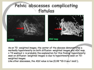 Presentation1, radiological application of diffusion weighted images in ...