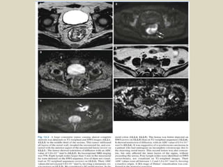 Presentation1, radiological application of diffusion weighted images in ...