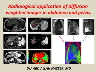 Dr/ ABD ALLAH NAZEER. MD.
Radiological application of diffusion
weighted images in abdomen and pelvis.
 