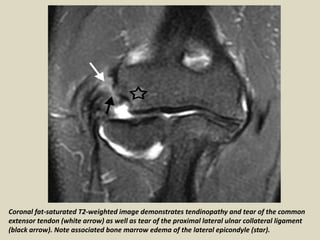 Presentation1, radiological film reading of elbow joint. | PPTX