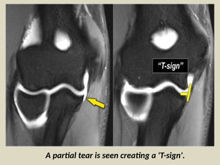 Comprehensive Radiological Film Reading and MRI Analysis of Elbow Joint ...