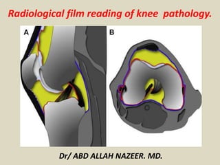Radiological film reading of knee pathology.
Dr/ ABD ALLAH NAZEER. MD.
 