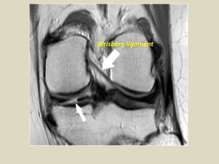 Presentation1, radiological film reading of knee joint. | PPTX