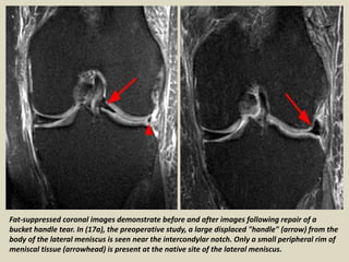 Partial Peripheral Rim Defect Presentation1, radiological film reading of knee joint. | PPTX