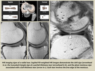 Triangle Tear Comprehensive Radiological Film Reading of Knee Meniscal Pathology and ...