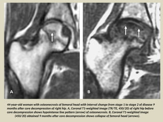 Comprehensive Radiological Analysis of Hip Joint Disorders: Avascular ...