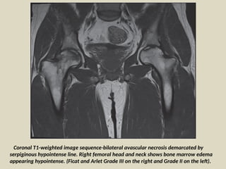 Comprehensive Radiological Analysis of Hip Joint Disorders: Avascular ...