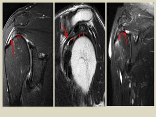 Comprehensive MRI and Radiological Imaging of Shoulder Joint ...