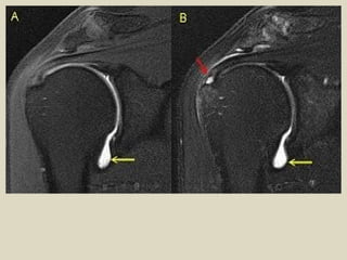 Comprehensive MRI and Radiological Imaging of Shoulder Joint ...