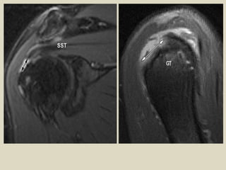 Comprehensive MRI and Radiological Imaging of Shoulder Joint ...