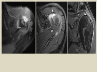 Comprehensive MRI and Radiological Imaging of Shoulder Joint ...