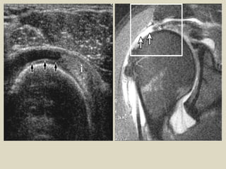 Comprehensive MRI and Radiological Imaging of Shoulder Joint ...