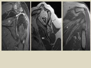 Comprehensive MRI and Radiological Imaging of Shoulder Joint ...
