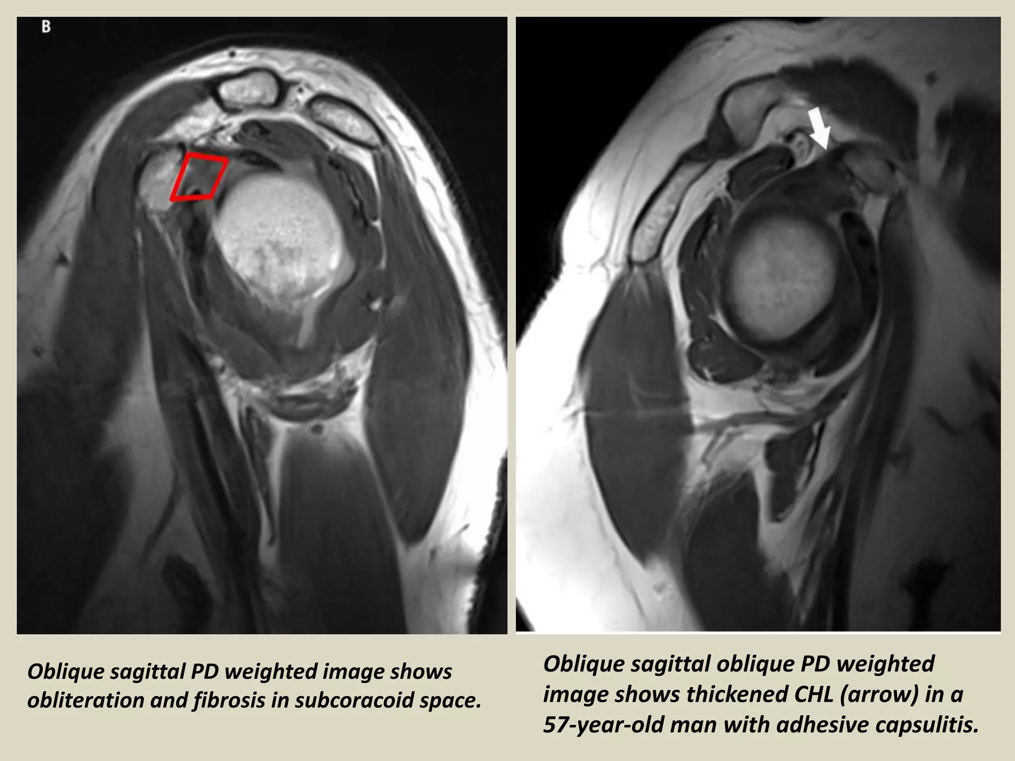 Presentation1, radiological imaging of adhesive capsulitis(frozen sho…