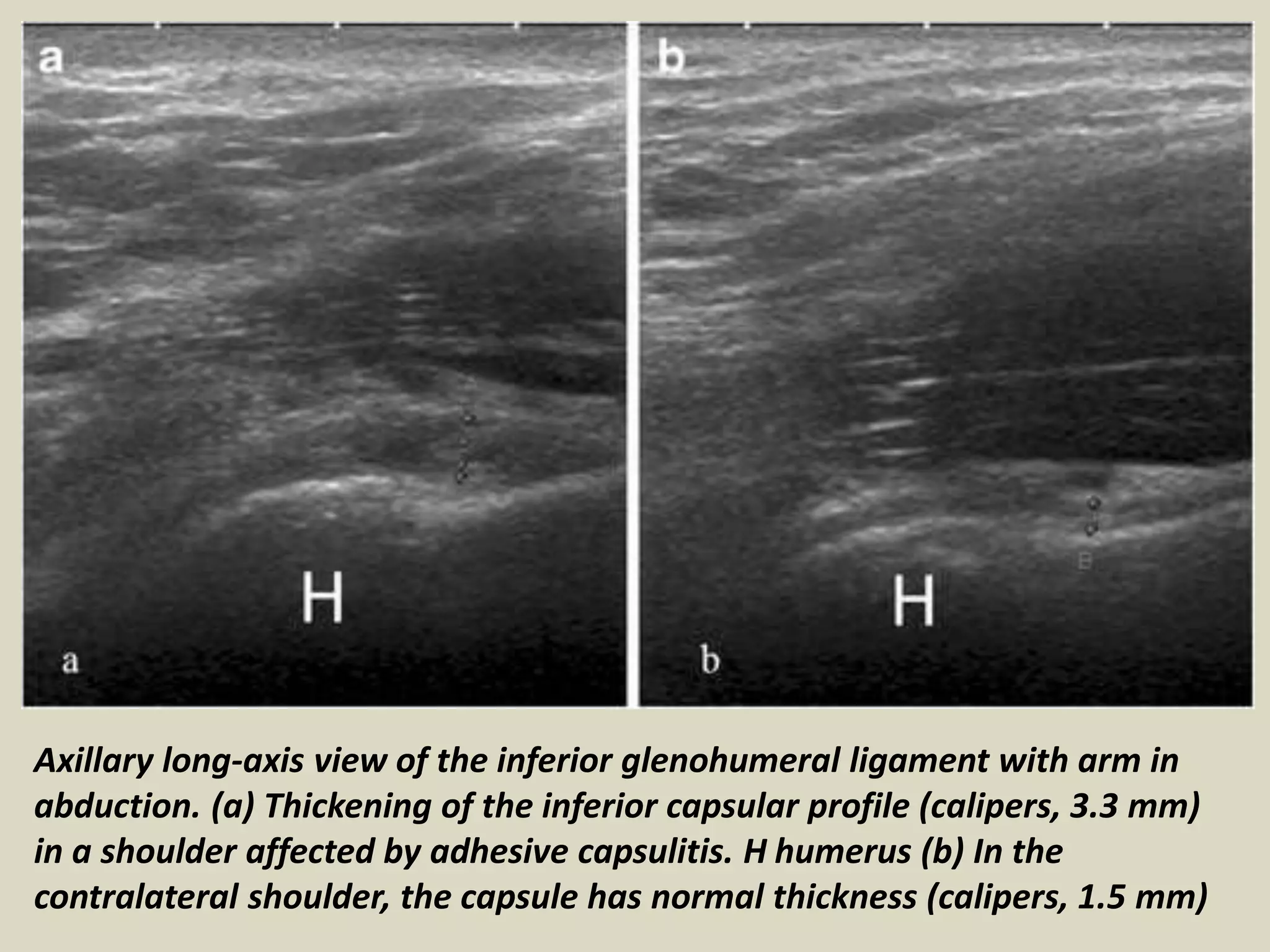 Presentation1, radiological imaging of adhesive capsulitis(frozen sho…