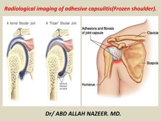 Dr/ ABD ALLAH NAZEER. MD.
Radiological imaging of adhesive capsulitis(Frozen shoulder).
 