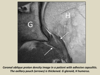 Axillary Pouch Radiology Presentation1, radiological imaging of adhesive capsulitis(frozen ...