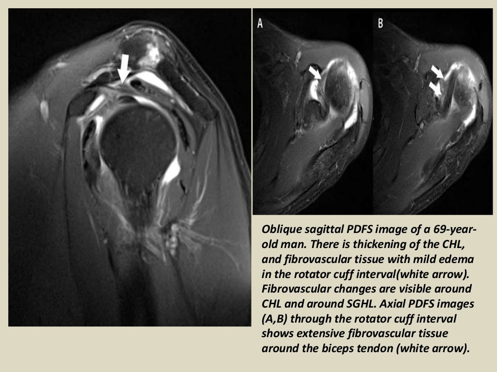 Presentation1, radiological imaging of adhesive capsulitis(frozen sho…