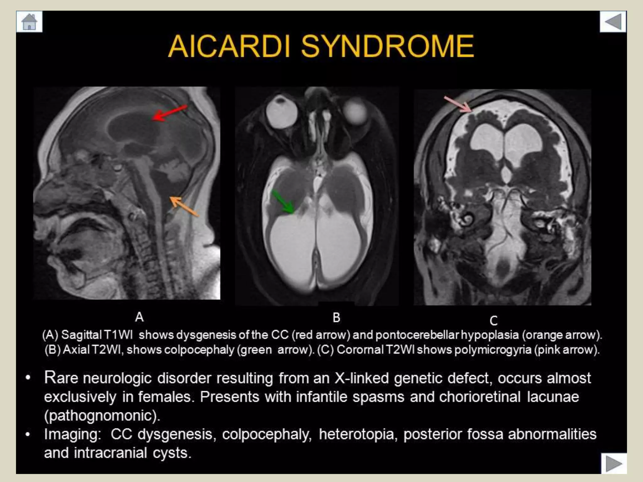 presentation1-radiological-imaging-of-aicardi-syndrome-pptx