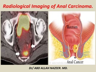 Radiological Imaging of Anal Carcinoma.
Dr/ ABD ALLAH NAZEER. MD.
 