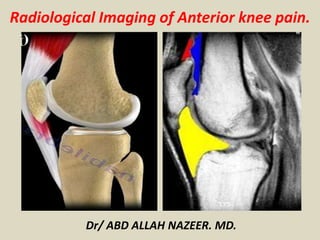 Radiological Imaging of Anterior knee pain.
Dr/ ABD ALLAH NAZEER. MD.
 