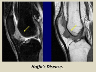 Presentation1, radiological imaging of anterior knee pain. | PPTX