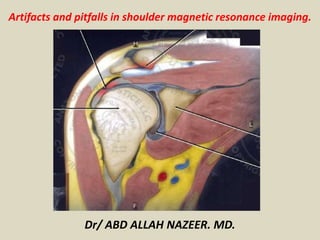 Artifacts and pitfalls in shoulder magnetic resonance imaging.
Dr/ ABD ALLAH NAZEER. MD.
 