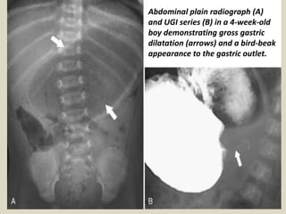 Hampton Line Presentation1, radiological imaging of barium studies. | PPTX