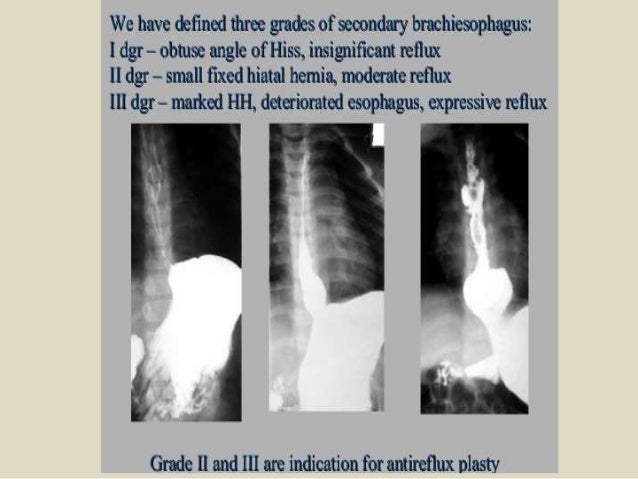 Barium Swallow Gerd Diagnosis - Nusagates