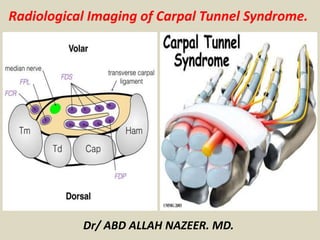 Radiological Imaging of Carpal Tunnel Syndrome.
Dr/ ABD ALLAH NAZEER. MD.
 