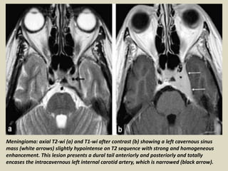Presentation1, radiological imaging of cavernous sinus lesions. | PPT