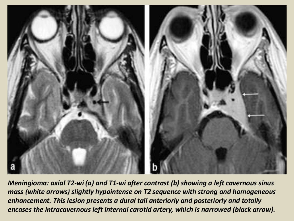 Presentation1, radiological imaging of cavernous sinus lesions.