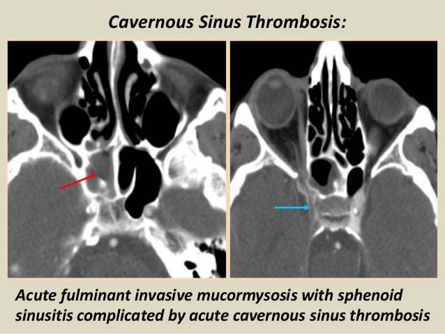 cavernous sinus thrombosis