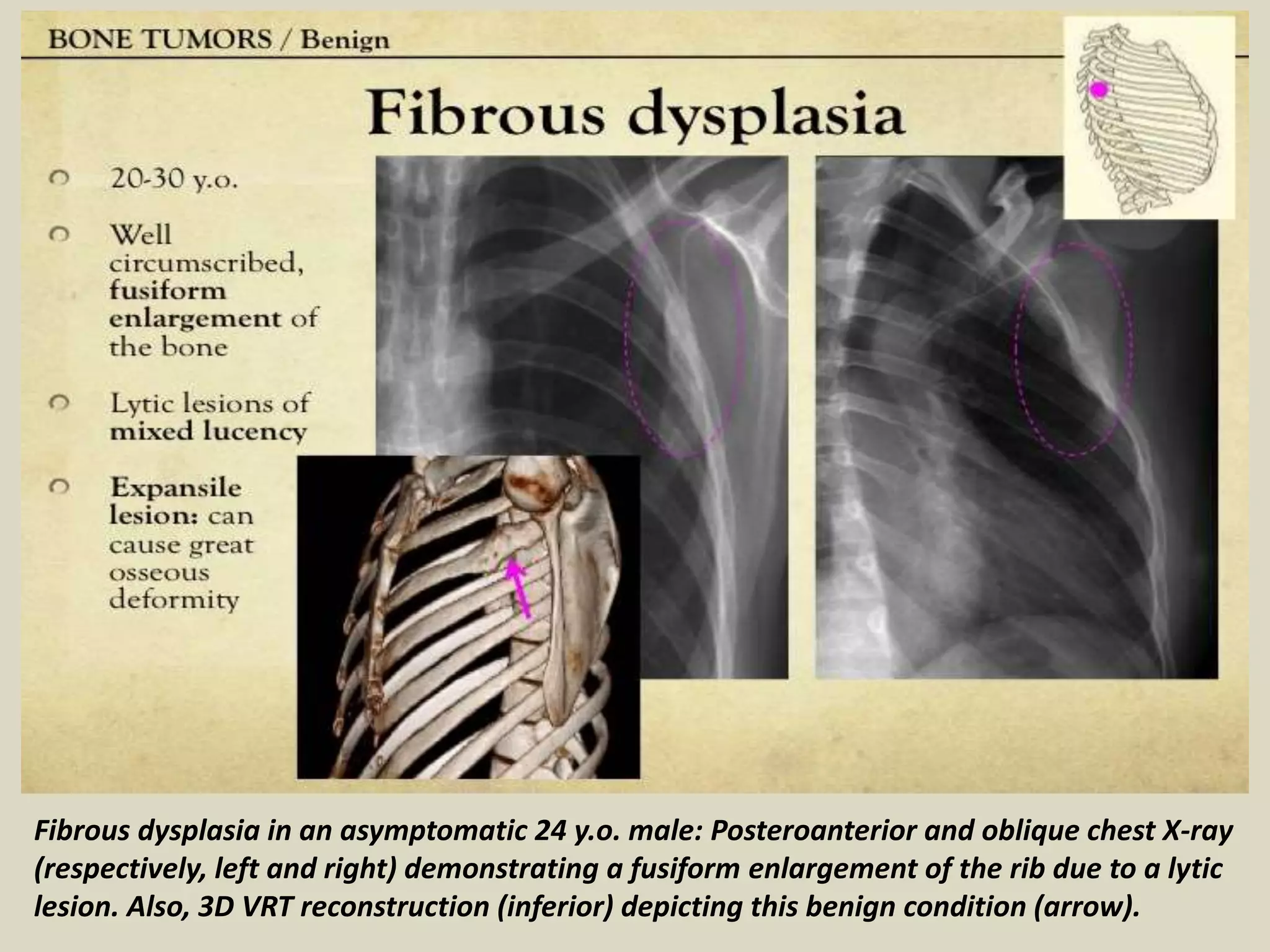 Presentation1, radiological imaging of chest wall tumour. | PPTX
