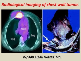 Dr/ ABD ALLAH NAZEER. MD.
Radiological imaging of chest wall tumor.
 