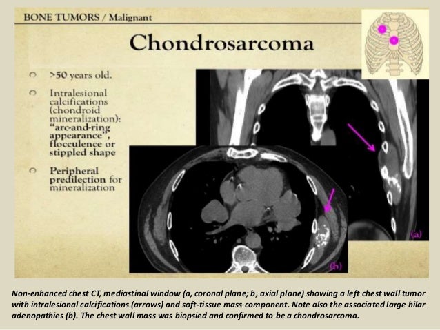 Presentation1, radiological imaging of chest wall tumour.