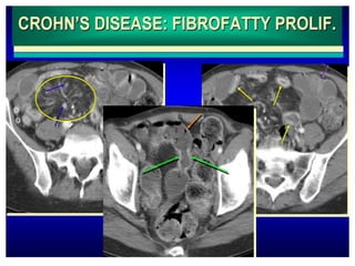 Presentation1, radiological imaging of colitis. | PPTX