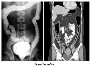 Presentation1, radiological imaging of colitis. | PPTX
